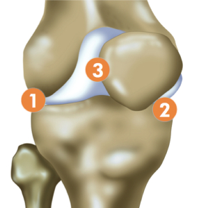 Bicompartmental OA_Femur