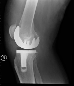 knee replacement