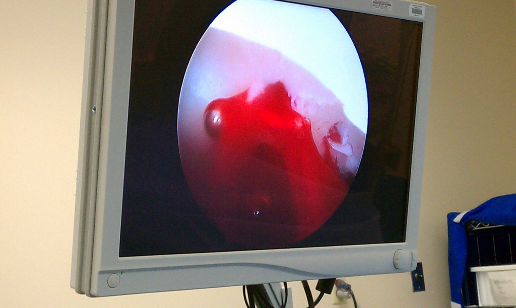 Arthroscopic microfracture for cartilage damage with the addition of PRP and stem cells.