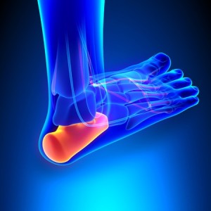 plantar fasciitis