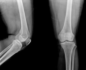 39099995 - x-ray of knee