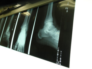 49341809 - radiograph of the ankle fracture