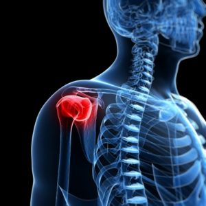 17911288 - 3d rendered illustration of a painful shoulder